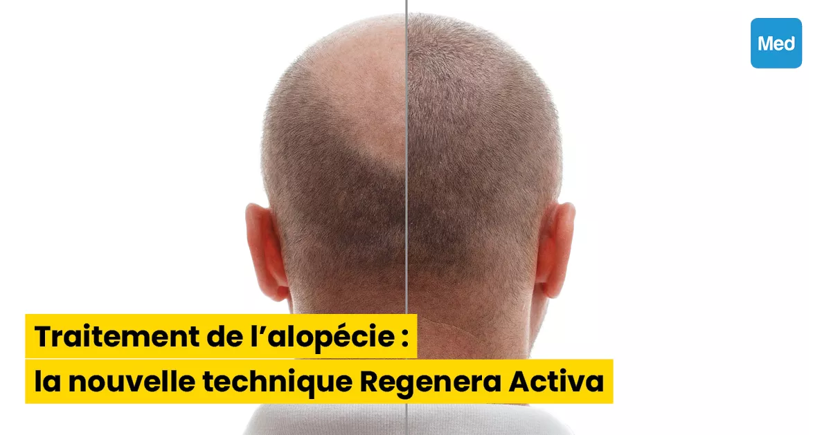Traitement de l'alopécie : la nouvelle technique Regenera Activa